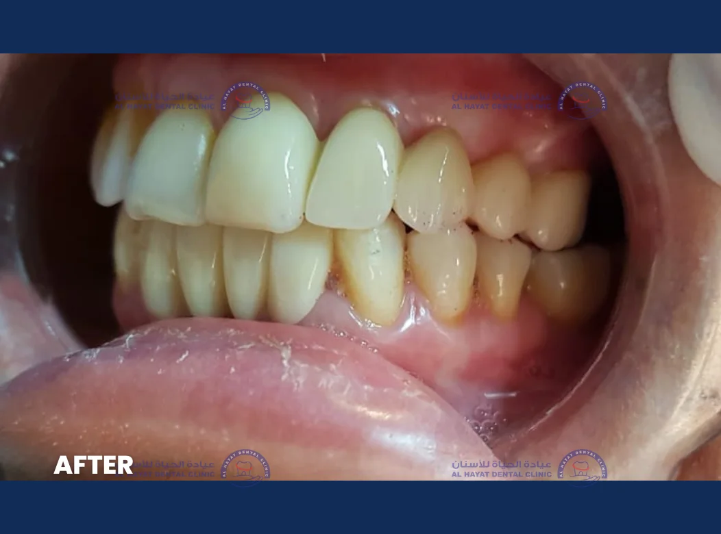 After - Crown Fixing