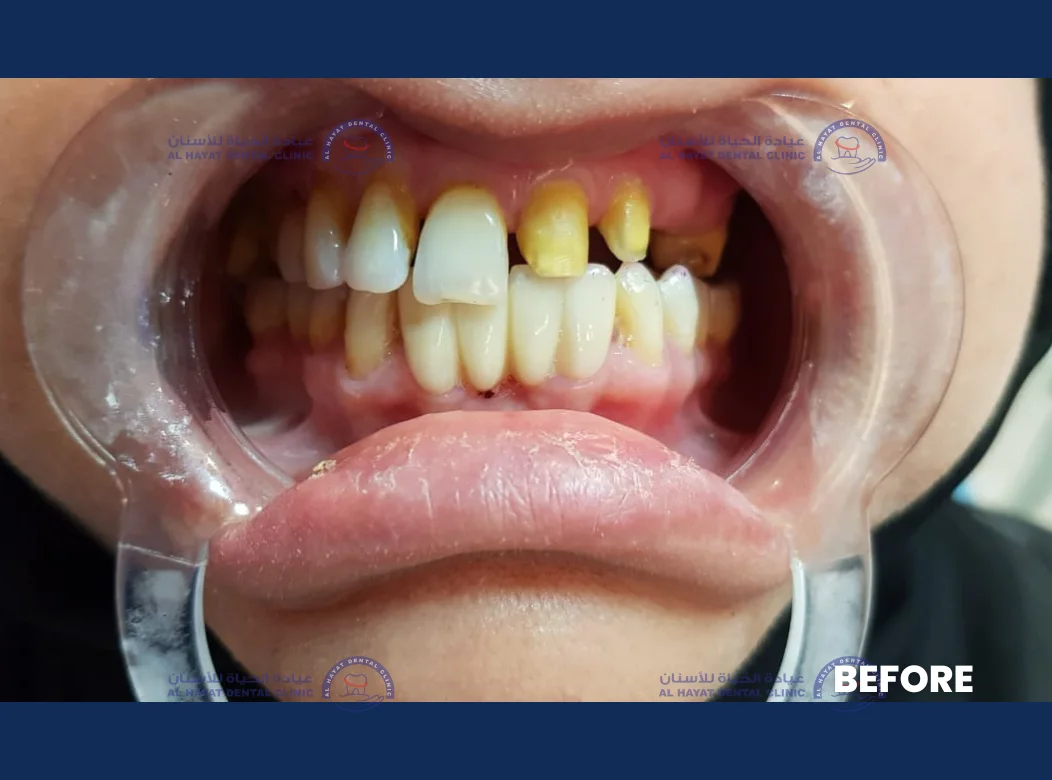 Before - Crown Fixing