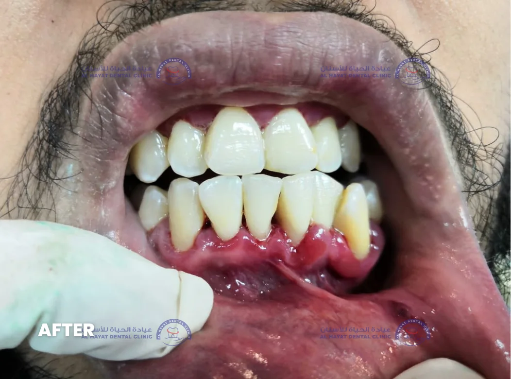 After - Dental Cleaning