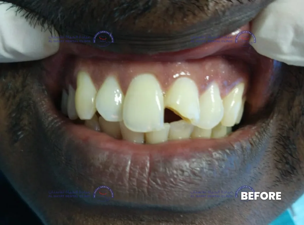 Before - Teeth filling